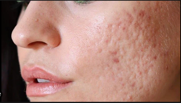 Why Use Niacinamide for Acne Scars?